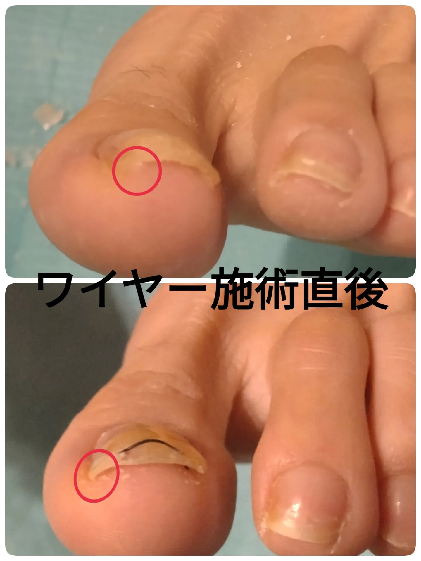 巻き爪矯正とフットケアサロンの料金や施術法